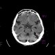 Subarachnoid hemorrhage, beam hardening artifact, pneumocephalus: CT - Computed tomography